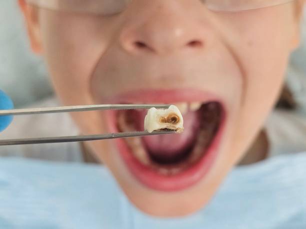 Best Knocked-Out Tooth (Avulsed Tooth) Treatment in Bremen, IN